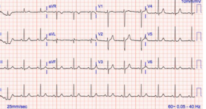 Read more about the article Electrocardiogram (EKG or ECG)
